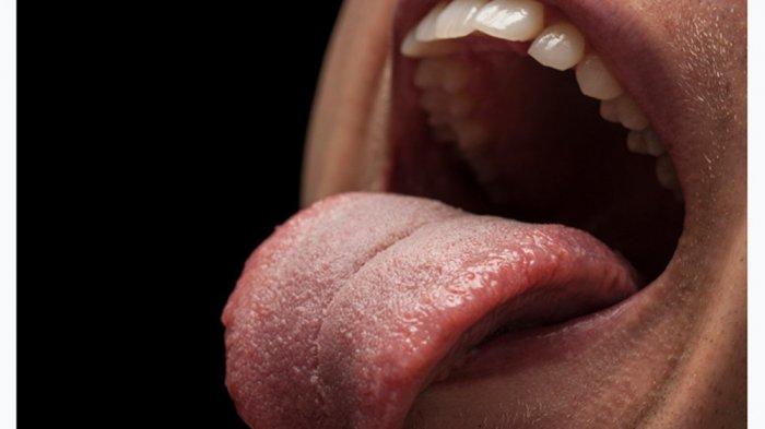 cara mengatasi lidah terbakar