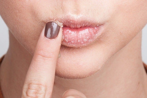 cara mengatasi bibir hitam