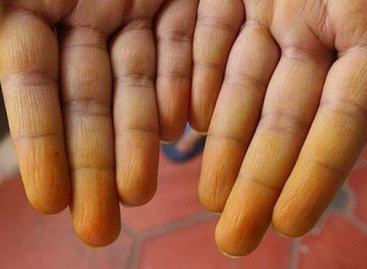 cara menghilangkan noda kunyit di tangan