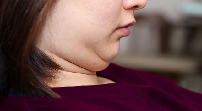 cara menghilangkan double chin