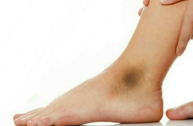 cara mengatasi mata kaki yang hitam