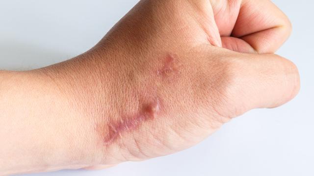 cara menghilangkan bekas jahitan