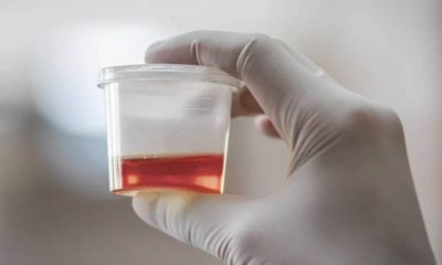 penyebab hematuria