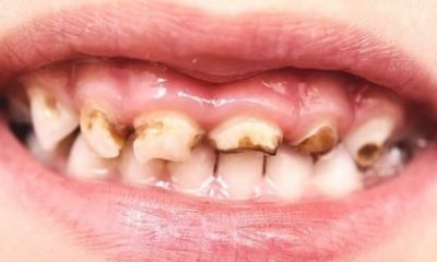 penyebab gigi anak hitam