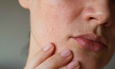 cara mengatasi alergi kosmetik
