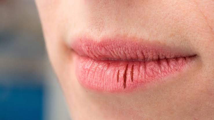 Tips Sederhana Mengatasi Bibir Kering Saat Berpuasa