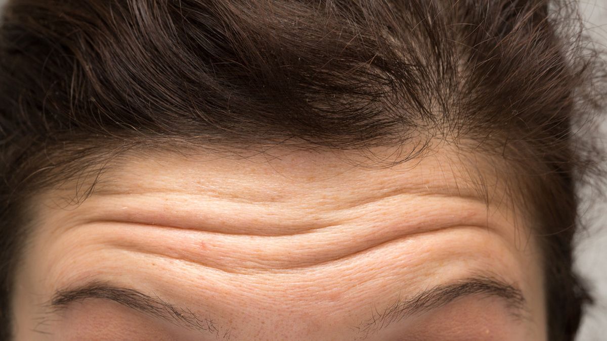 cara menghilangkan kerutan di dahi