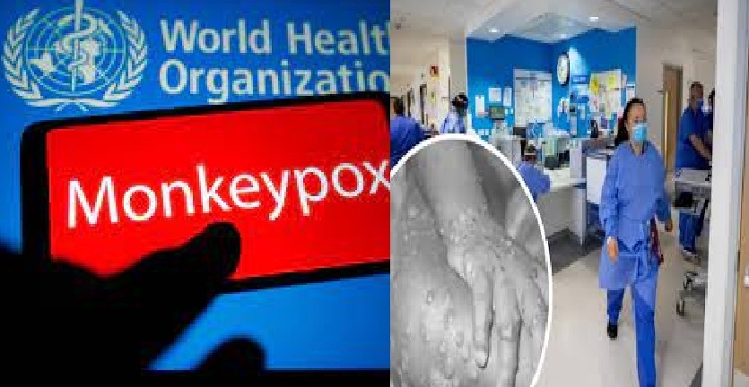WHO mengemukakan virus Cacar Monyet kini telah terdeteksi di 16 negara di luar Afrika