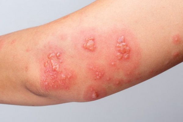 Cara Mengobati Herpes