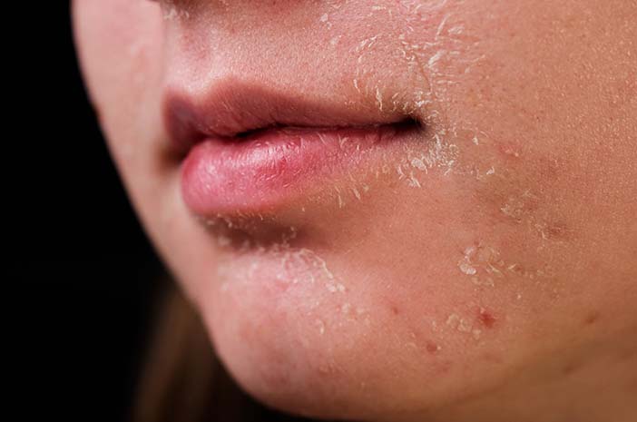 Kulit Wajah Menjadi Kering dan Terkelupas