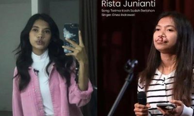 Tompi Berhasil Ubah Wajah Rista Junianti yang Berbibir Sumbing Jadi Lebih Cantik
